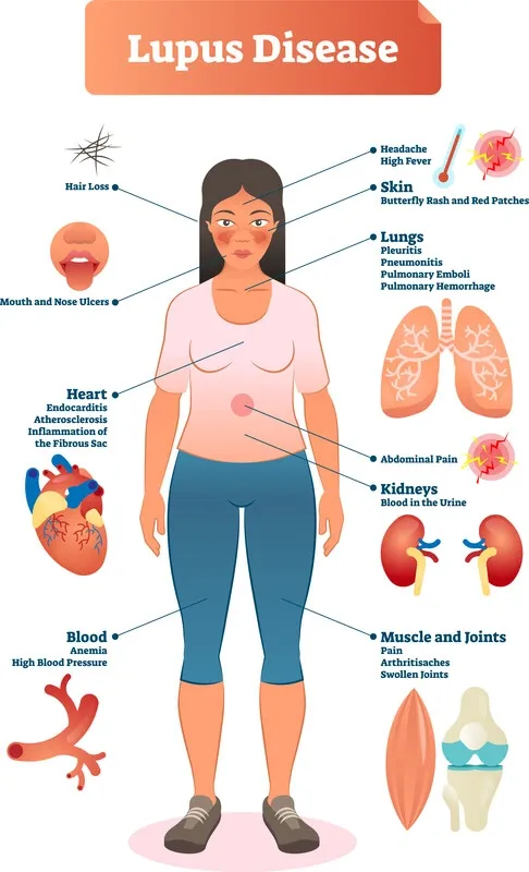 “Unraveling the Mystery: Deepening Our Grasp on Lupus and Its Impact” - United Together Lupus Foundation, Saginaw MI (photo 4)